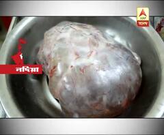 অস্ত্রোপচারে পেট থেকে বেরোল ৩৫ কেজির টিউমার!