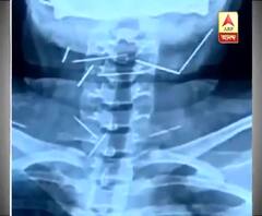 গলায় সূচ বিঁধে থাকা ১৪ বছরের কিশোরীর অবস্থা অস্ত্রোপচারের পর স্থিতিশীল