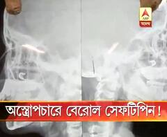 হাঁচতে গিয়ে নাকে ঢুকল সেফটিফিন, অস্ত্রোপচার করে বের করা হল মুখ দিয়ে