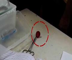 খেলতে খেলতে ১১ মাসের শিশুর গলায় আটকে গেল বোতলের ছিপি, চিকিত্সকদের তত্পরতায় প্রাণ বাঁচল শিশুর